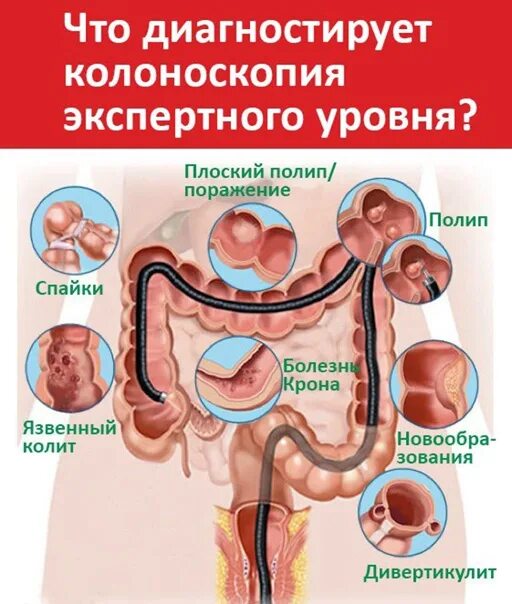 Колоноскопия кишечника. Подготовка к колоноскопии кишечника. Кишечник форум врачей