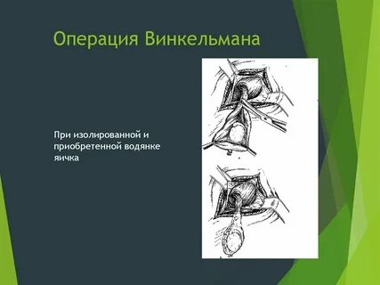 Операция бергмана