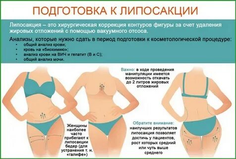 Где делают липосакцию