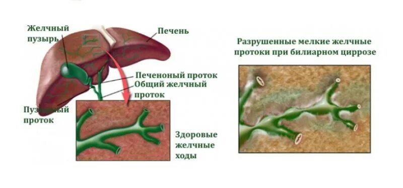 Первичный билиарный цирроз печени препарат. Печень внутрипеченочные желчные протоки анатомия. Внутрипеченочные желчные протоки гистология. Пузырный проток желчного. Заболевания желчных протоков