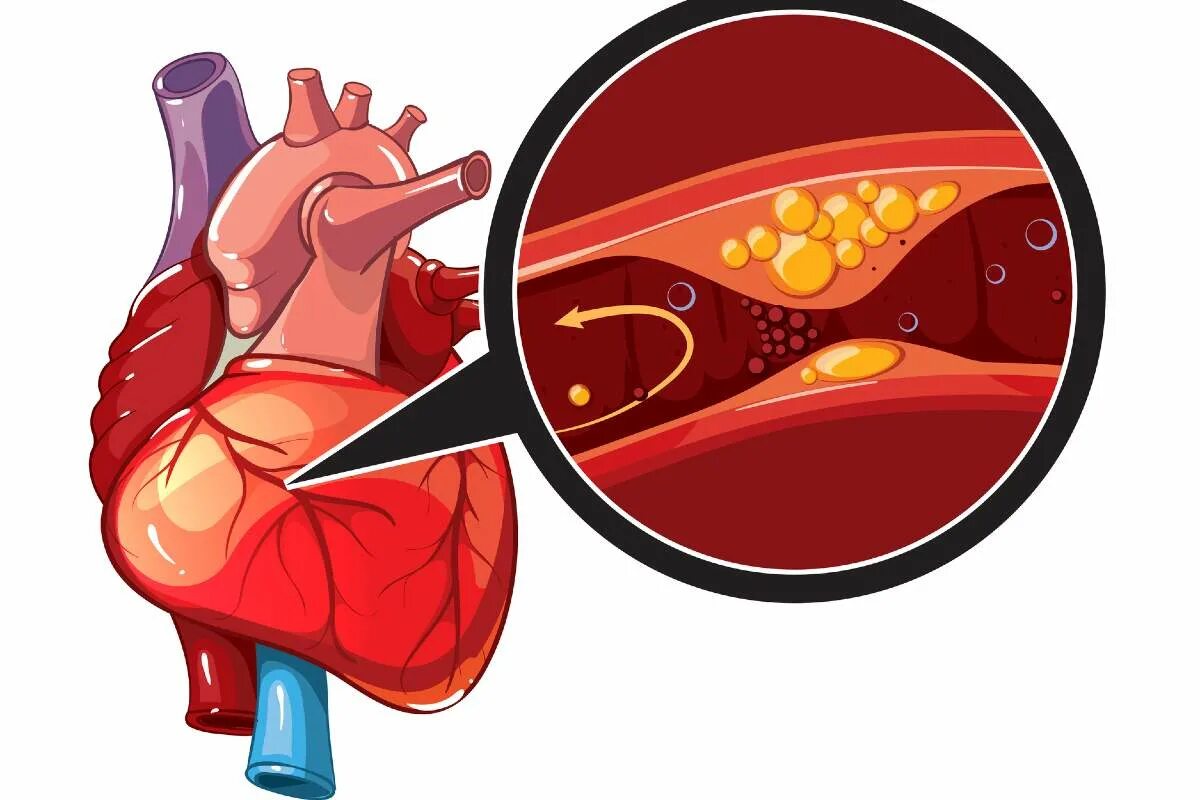 Инфаркт миокарда сердце. Аритмия атеросклероз. Болезнь сердца название. Аритмия атеросклероз. Аритмия атеросклероз.