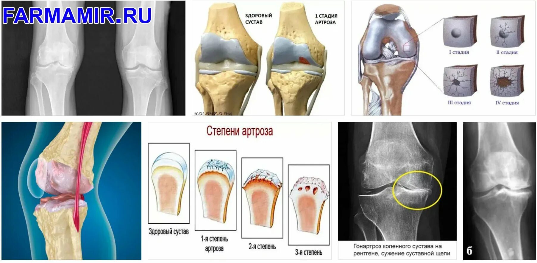 Коленный сустав по стадиям. Деформирующий артроз 2 степени. Первичный гонартроз коленного сустава 1. Деформирующий гонартроз коленного сустава 2-3 степени.