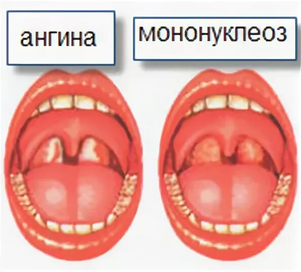 Моноклиоз. Герпесное вирусная ангина. Агранулоцитарная ангина. Инфекционный мононуклеоз зев.