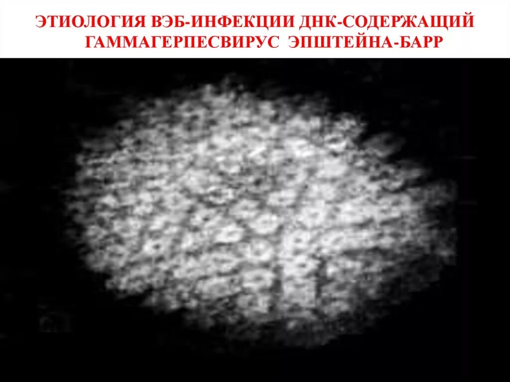 Вирус эпштейна барра болеют. Вирус эпштейна-барр клиника. днк вируса эпштейна-барр. вирус эпштейна-барр этиология.