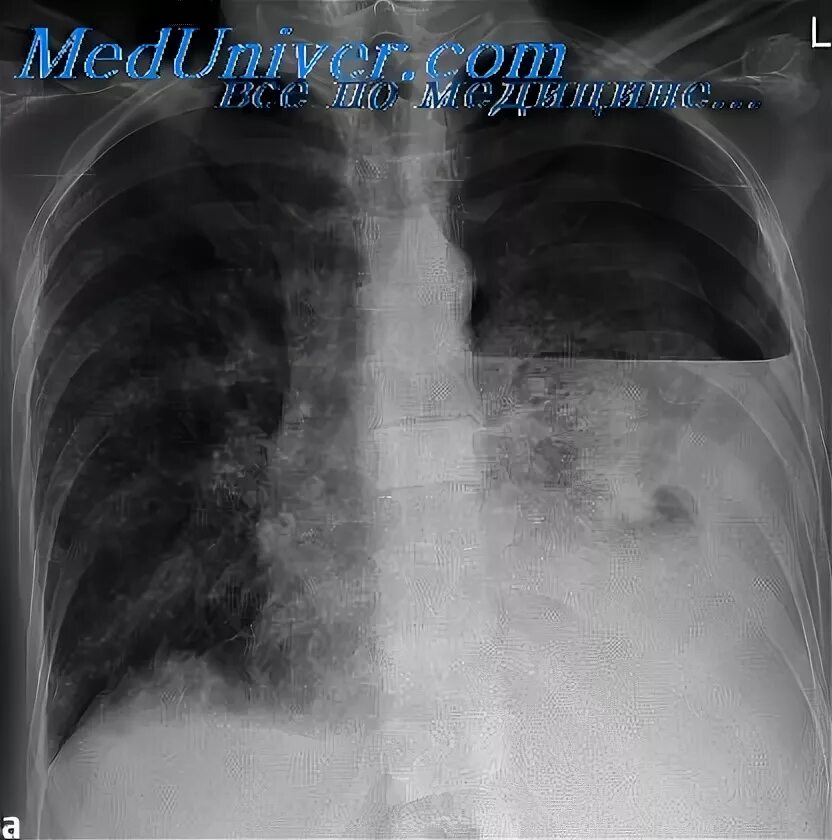Полость распада при туберкулезе. Канцероматоз легких рентген. Полость распада туберкулеза легком.