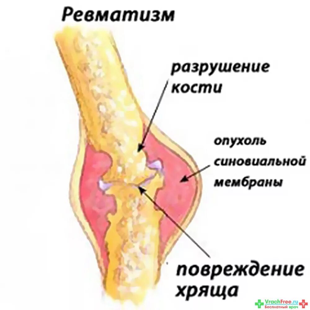 Как лечить ревматизм суставов. Ревматизм поражение суставов.