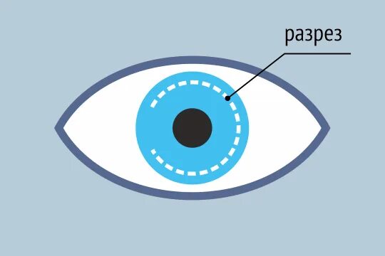 Схема разреза при методе ласик. Схема разреза при LASIK. ФЕМТОЛАСИК схема. Сделайте кольцевой надрез