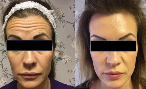 Wrinkle Injections: Before And After Pictures.