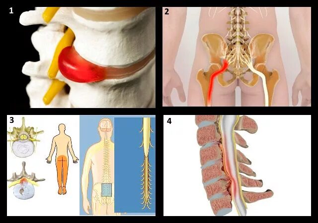 Защемление корешков в пояснице. Грыжа позвоночника поясничного крестцового. Остеохондроз крестцового отдела позвонка. Грыжа позвоночника симптомы пояснично-крестцовый. Грыжа остеохондроз пояснично крестцового отдела позвоночника.