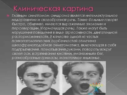 Синдромы психического недоразвития