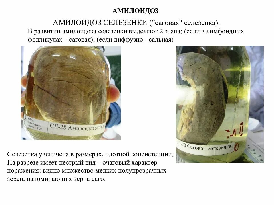 Саговая селезенка. Амилоидоз сердца макропрепарат. Сальная селезенка макропрепарат. Амилоидоз печени макропрепарат. Амилоидоз селезенки макропрепарат.