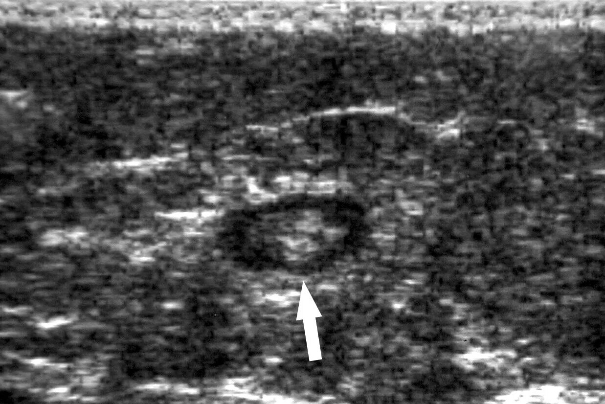 фиброаденома молочной железы на узи. фиброаденома молочной железы узи снимок. как выглядит фиброаденома на узи. как выглядит фиброаденома на узи. фиброаденоматоз молочной железы на узи.