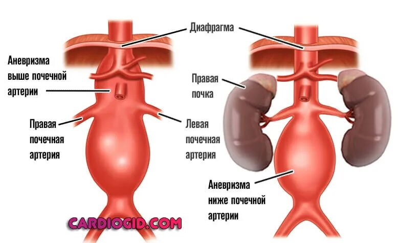 Аневризматическое расширение почечной артерии. Аневризма брюшной аорты УЗИ. Аневризма брюшной артерии симптомы. Аневризма правой почечной артерии.