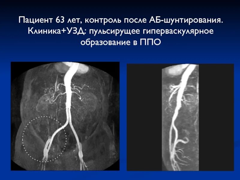 Гиперваскулярное образование почки что это такое. Гиперваскулярное образование что это. высокоцеллюлярное, гиперваскулярное образование. гиперваскулярные узелки. гиперваскулярное в нативную фазу образование почки.