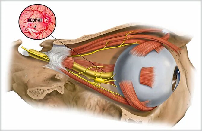 Неврит оптического нерва. Ретробульбарный неврит. Ретробульбарный неврит зрительного нерва. Неврит глазного нерва ретробульбарный. Периневральное пространство зрительного нерва