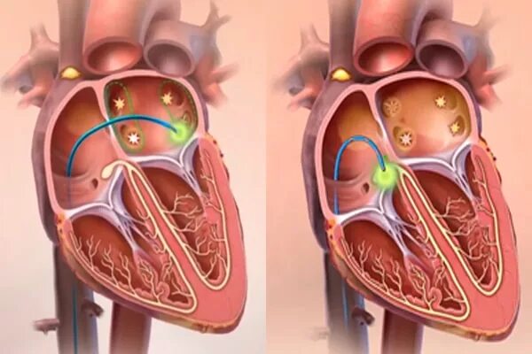 Рча предсердий. Катетерная абляция фибрилляции предсердий. Катетерная абляция сердца что это такое. Катетерная деструкция.