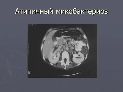 Микобактериоз