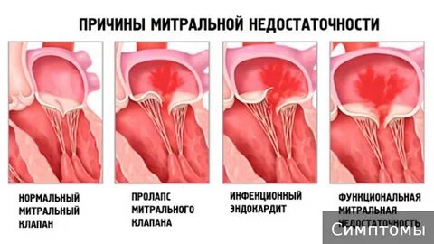 Пролапс клапана операция