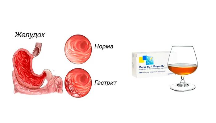 При гастрите что можно пить из напитков. Напитки при гастрите.