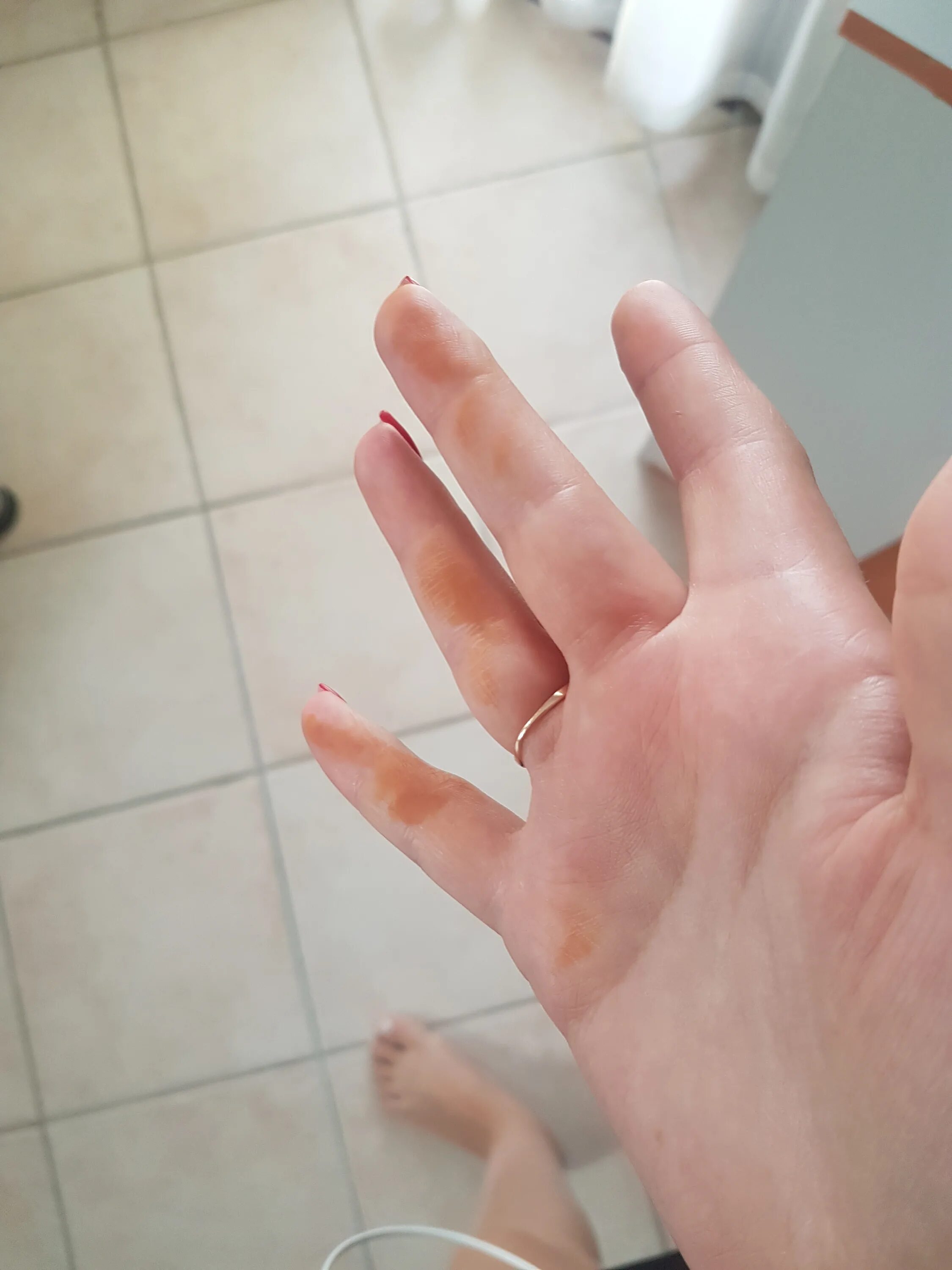 Коричневые руки почему. Оранжевые пятна на пальцах рук. Оранжевые пятна на пальцах.