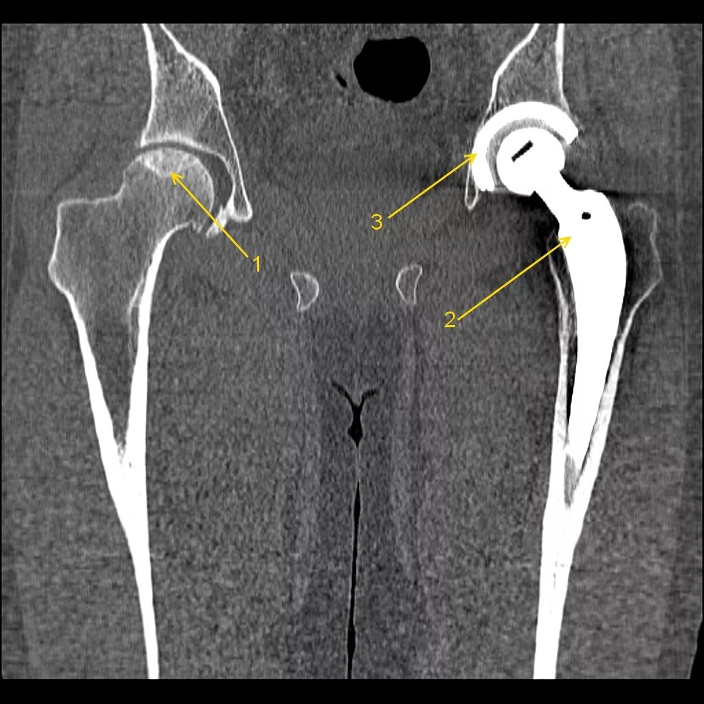 Мрт после эндопротезирования. Коксартроз тазобедренного сустава мрт. Коксартроз тазобедренного сустава кт. Эндопротез тазобедренного сустава кт. Эндопротез тазобедренного сустава мрт.
