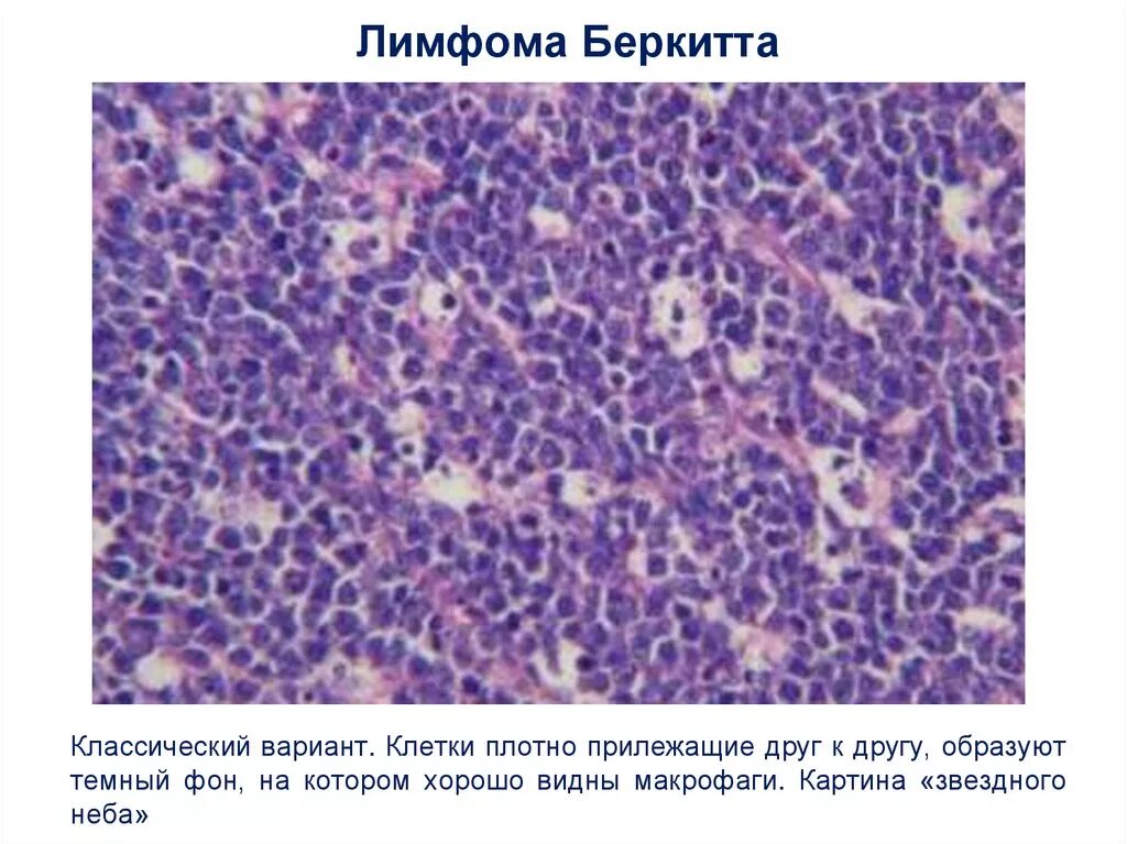 Неходжкинская лимфома гистология. Лимфома Беркитта Эпштейн Барр. Лимфома Беркитта патанатомия микропрепарат. Лимфосаркома Беркитта. Лимфоидная опухоль