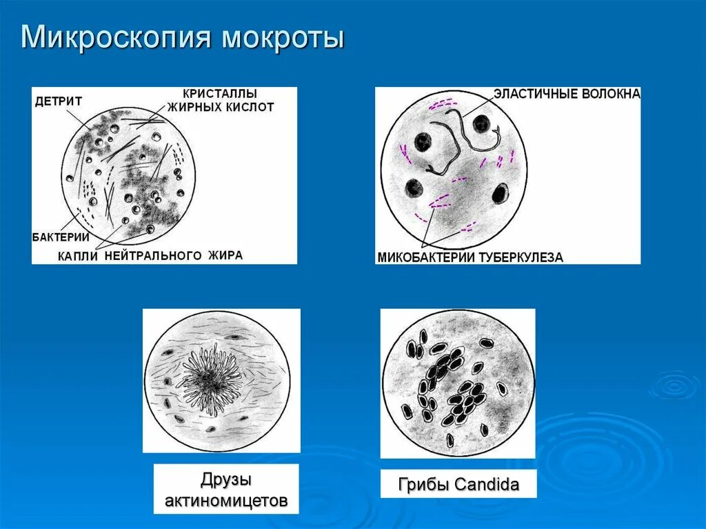 Микроскопическое исследование нативного препарата мокроты. Клеточные элементы мокроты микроскопия. Эпителий в мокроте микроскопия. Мокрота нативный препарат микроскопия.