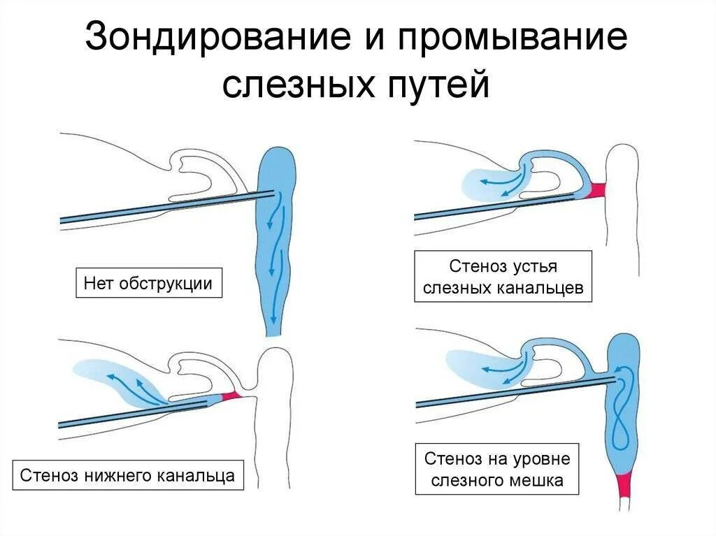 Как делают зондирование слезного. Зондирование и промывание слезных путей. промывание слёзных путей методика. промывание слезных путей алгоритм. зондирование слезных путей у новорожденных.