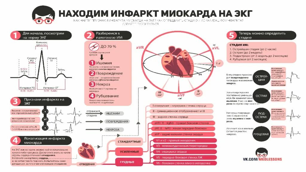 Признаки инфаркта как распознать инфаркт. Инфаркт миокарда классификация ЭКГ. Классификация инфаркта миокарда по ЭКГ. ЭКГ-диагностика инфаркта миокарда кратко. Локализация инфаркта миокарда по ЭКГ.