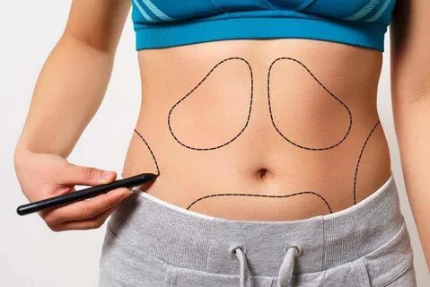 Liposuction surgery in Dubai