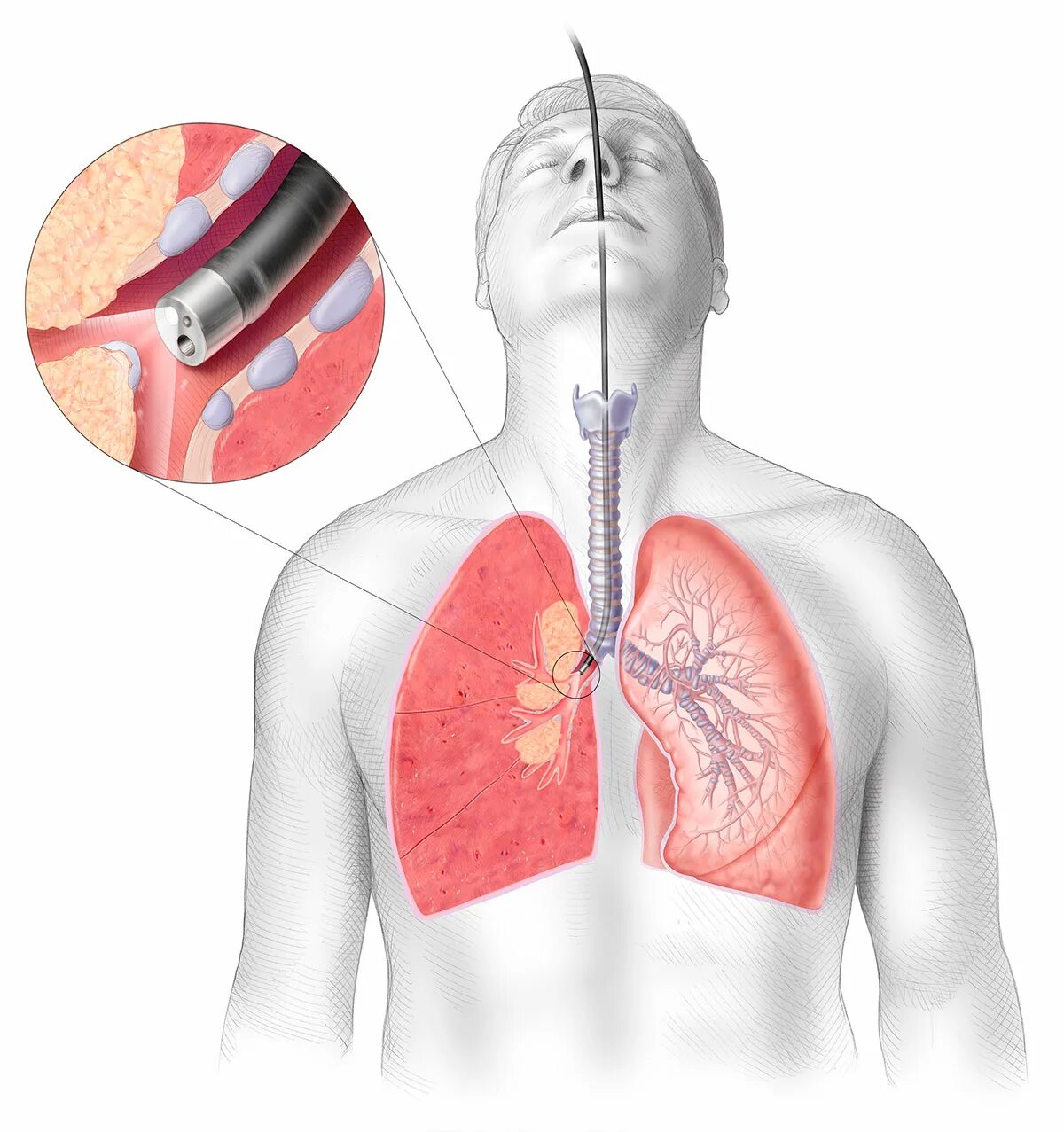 Что делают легкие при кашле. Легочное кровотечение бронхоскопия. Фибробронхоскопия легочное кровотечение. Туберкулез бронхов бронхоскопия. Пневмония бронхоскопия.