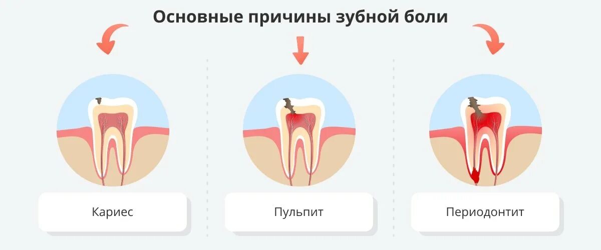 Ноющая боль в зубе причина.