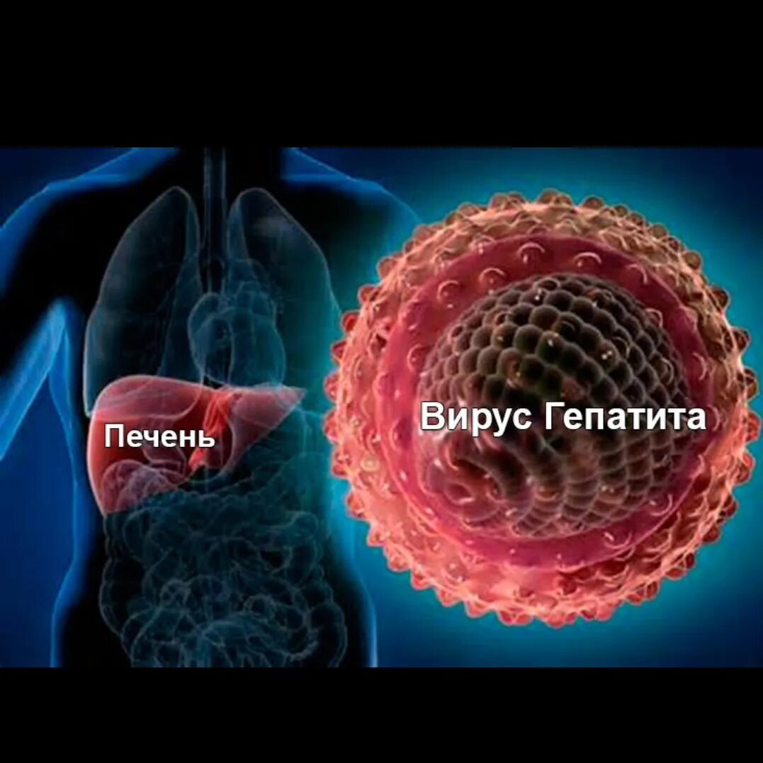 Вирусный гепатит печени. Вирусный гепатит д печень.