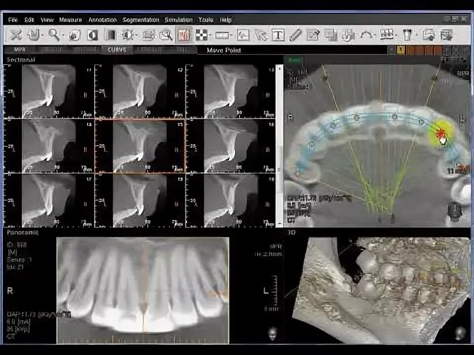 Программы для планирования имплантации. Программа для просмотра кт в 3d. Ez3d Plus. Ez3d2009