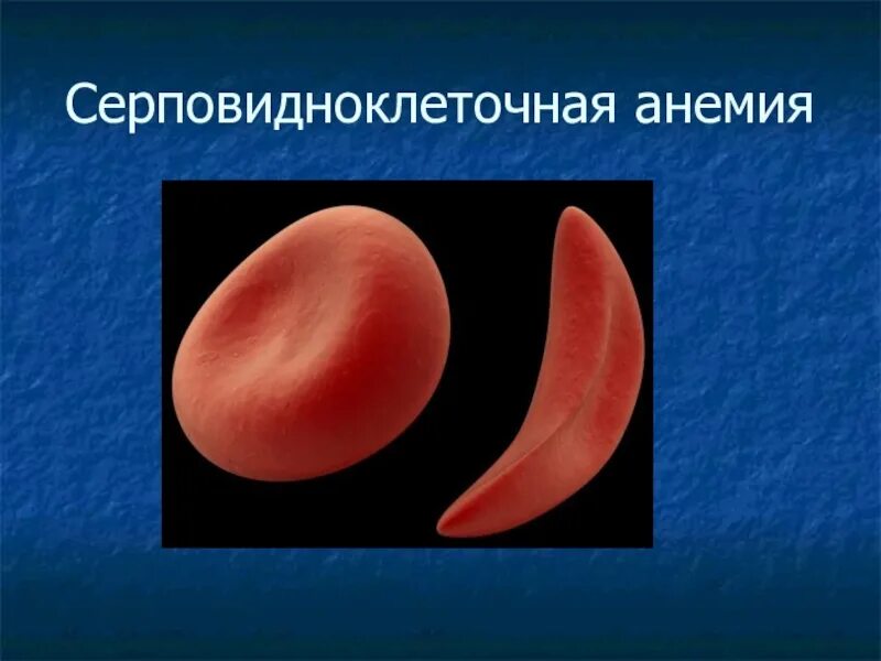 Серповидные эритроциты анемия. Серповидно клеточная анемия эритроциты. hbs серповидноклеточная анемия. серповидно-клеточная анемия (s-гемоглобинопатия). серповидноклеточная анемия эритроциты форма.