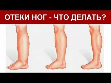 Отекают ноги в жару причины у женщин