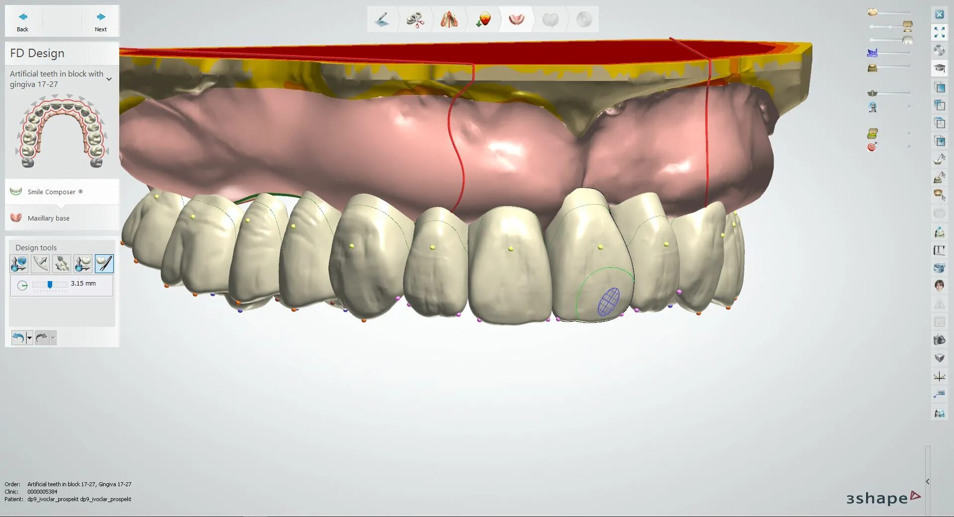 3shape разборные вкладки. Разборная молель3shape. Гнатометр Ивокляр. Интернет операция 3ds