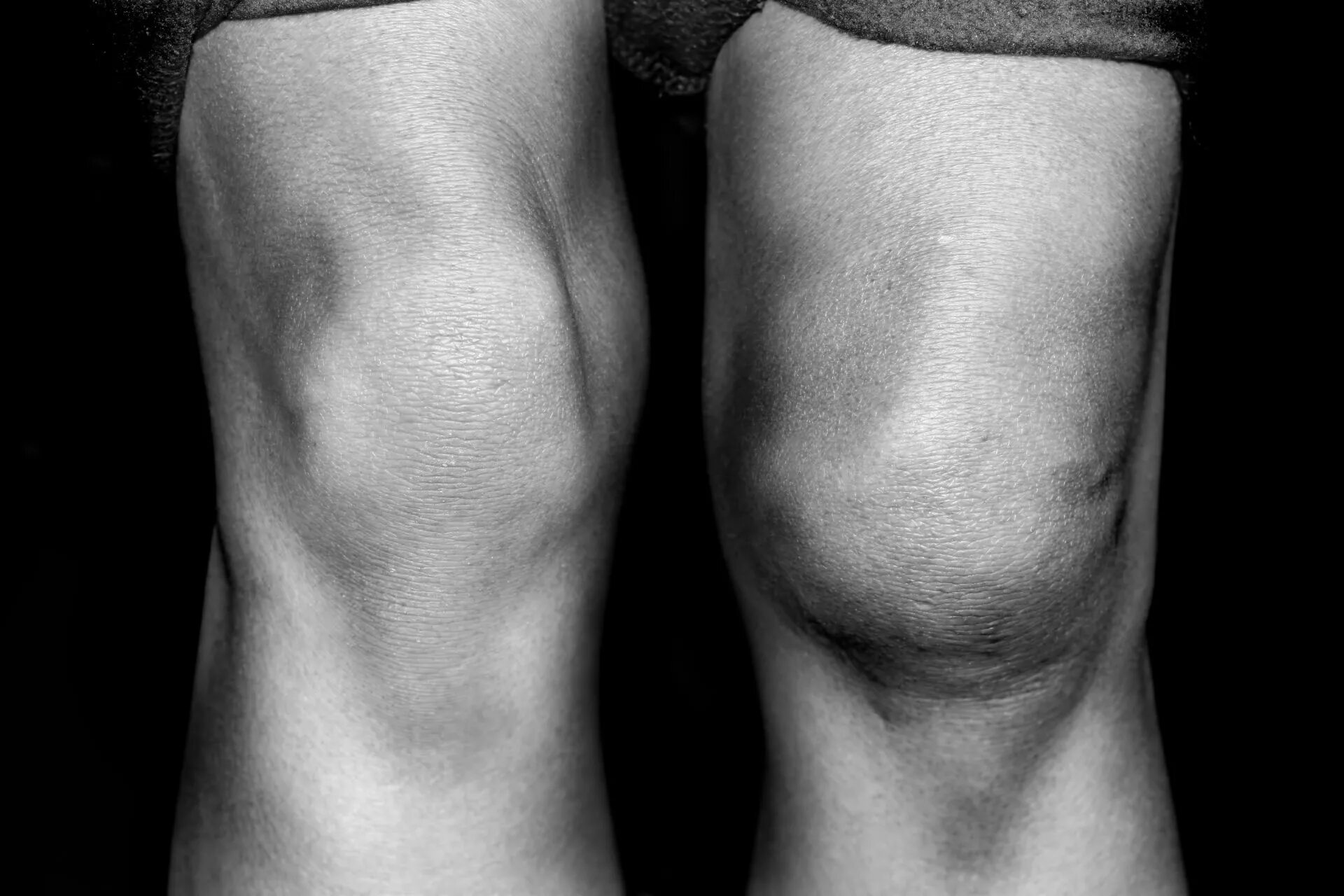 Боли коленного сустава симптомы. Синовит коленного сустава. Бурсит и синовит коленного. Инфрапателлярный бурсит.
