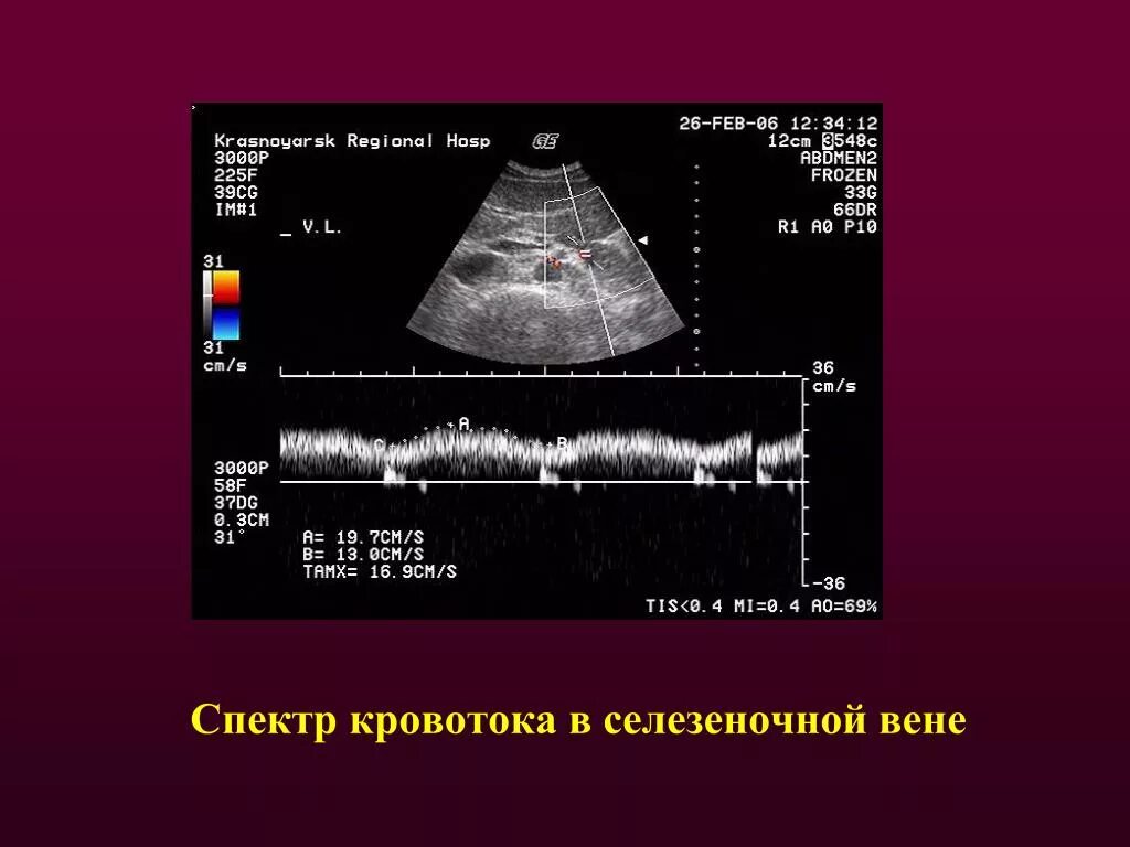 Доплер кровотоки. Допплерография, спектр кровотока. Ультразвуковая допплерография воротной вены. Скорость кровотока в селезеночной Вене УЗИ. Допплерография сосудов печени.