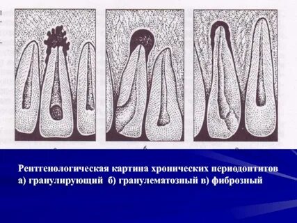 Лечение хронического фиброзного периодонтита