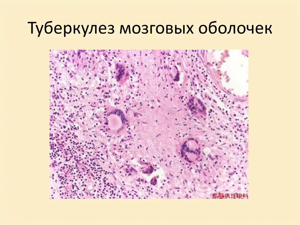 Туберкулез головного. Туберкулез головного мозга микропрепарат. Туберкулёз центральной нервной системы и мозговых оболочек. Туберкулезный менингит макропрепарат. Туберкулезный менингит микропрепарат.