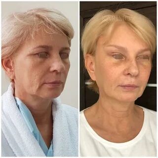 Эндоскопическая операция лба