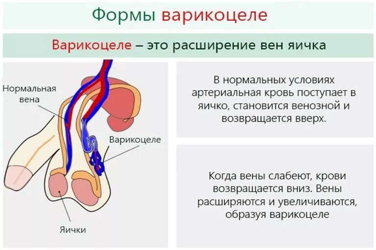 Варикозное расширение вен семенного канатика. Варикоцеле-расширение вен семенного канатика яичка. Варикозное расширение вен семенного канатика II степени. Варикозное расширение вен семенного канатика яичка.. Болит в правом яичке у мужчин