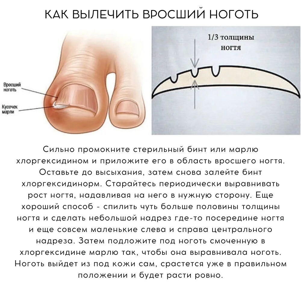 Как подстригать ноготь большого пальца ноги. Вросший ноготь начальная стадия.