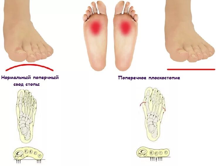 Поперечное 1 степени. Поперечное плоскостопие мкб 10. Симптомы продольного и поперечного плоскостопия. Поперечный и продольный свод стопы плоскостопие. Нормальный свод стопы и плоскостопие.