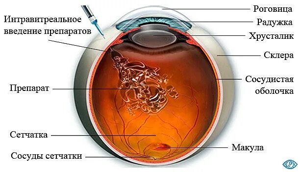 ивв озурдекс. введение луцентиса в глаз. интравитреальный имплантат. озурдекс 0,0007 имплант д/интравитреаль введ. анти-vegf интравитреальное введение.