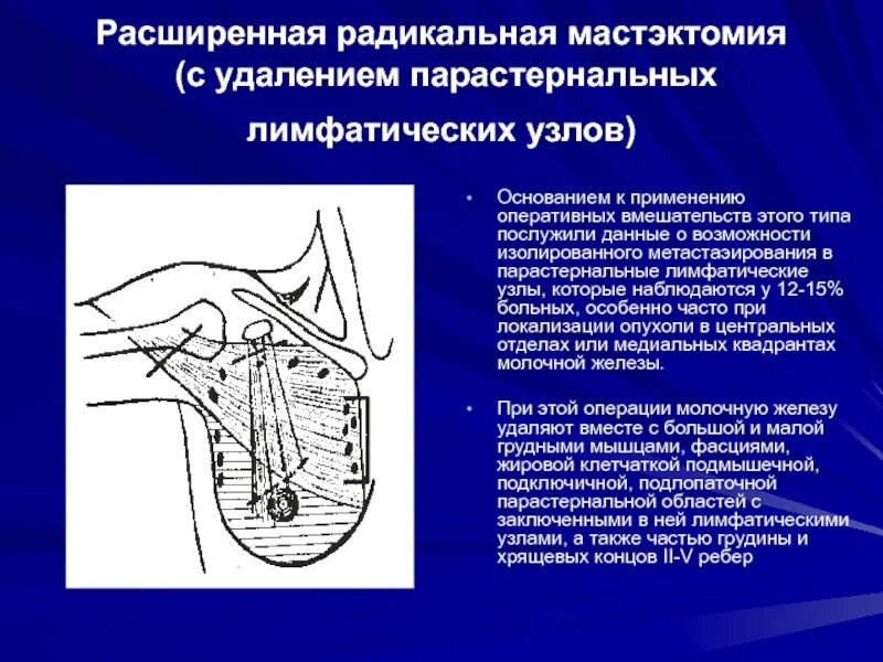 Как удаляют лимфатические узлы Резекция лимфатических узлов
