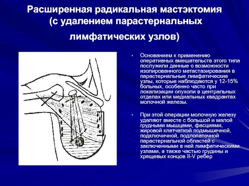 Операция лимфатические узлы. • Радикальная мастэктомия по Halsted Mayer. Операция по Холстеду Майеру. Радикальная мастэктомия молочной железы операция. Ракидальная Мактэктомия.