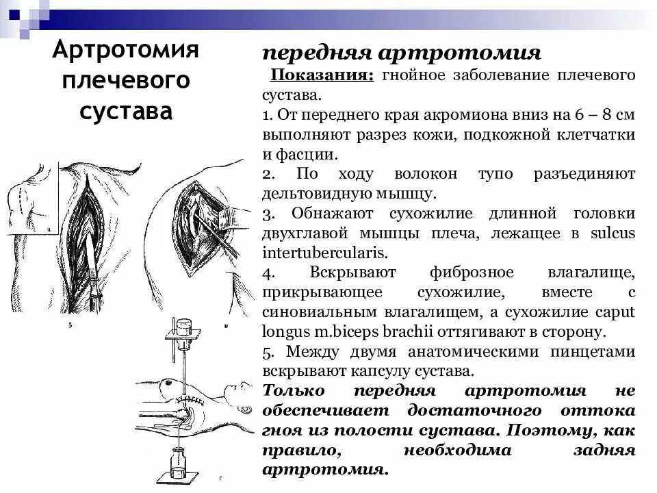 Артротомия плечевого сустава. Артротомия коленного сустава по Лангенбеку. Передняя артротомия плечевого сустава по Лангенбеку. Пункция артротомия и резекция коленного сустава. Артротомия плечевого сустава техника операции.