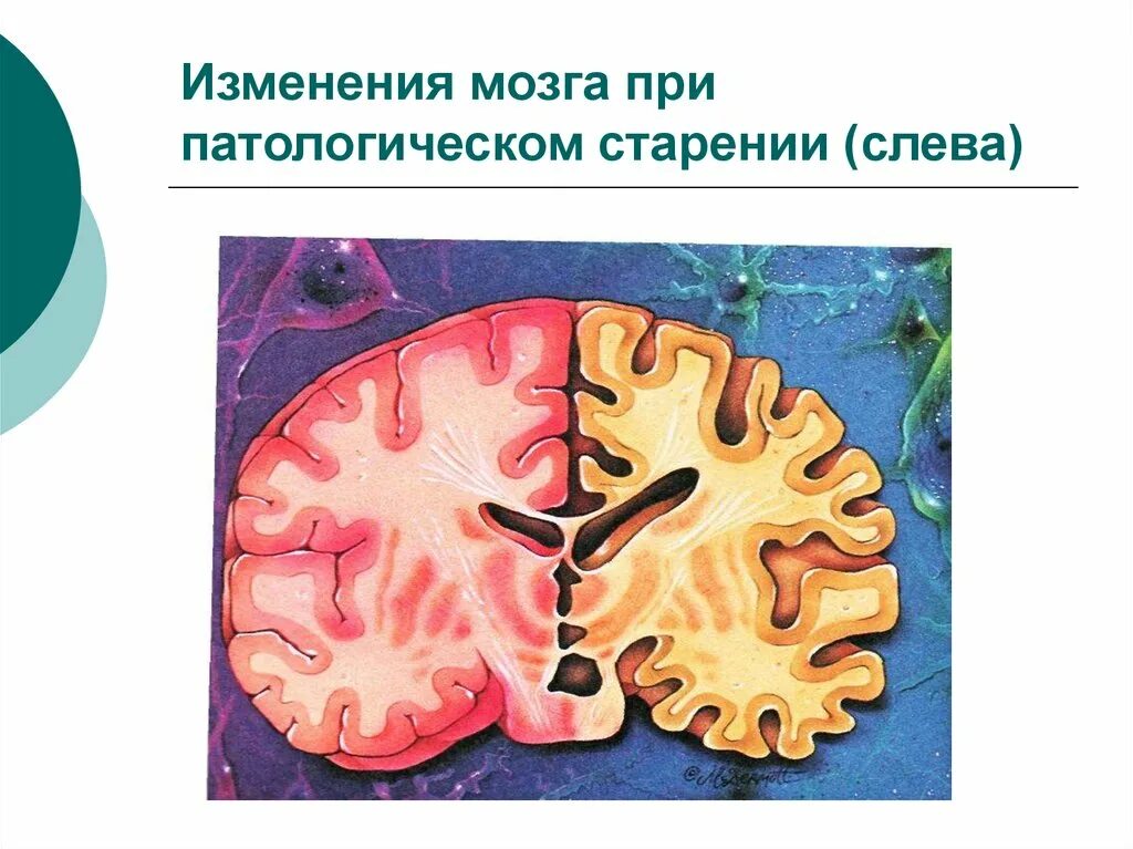 Вызвать изменения мозгу изменения. Изменения мозга при патологическом старении. Патологическое старение. Патологическая старость. Что происходит при патологическом старении.